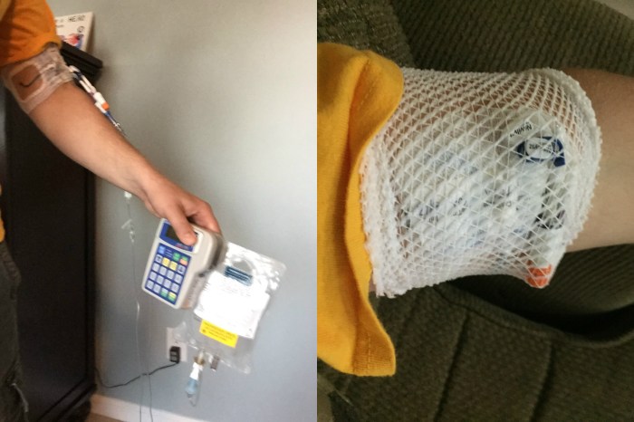 On the left is my 24/7 hookup to the IV pump and Blinatumomab. On the right is me unhooked :)