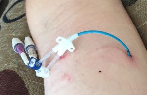 My PICC during dressing change.